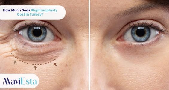 How Much Does Blepharoplasty Cost in Turkey