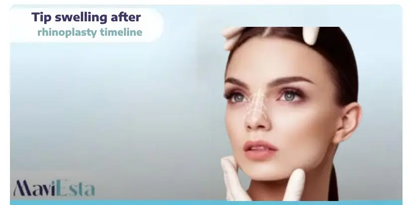 tip swelling after rhinoplasty timeline