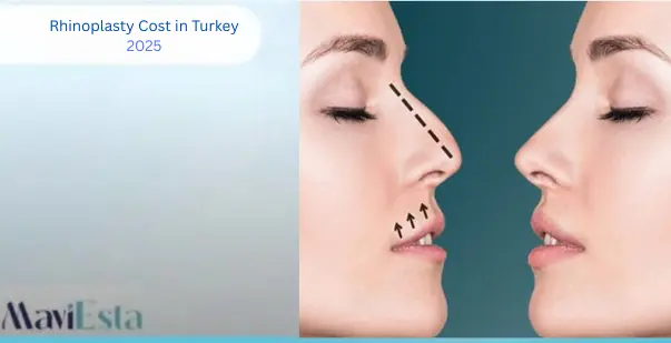 Rhinoplasty cost in Turkey
