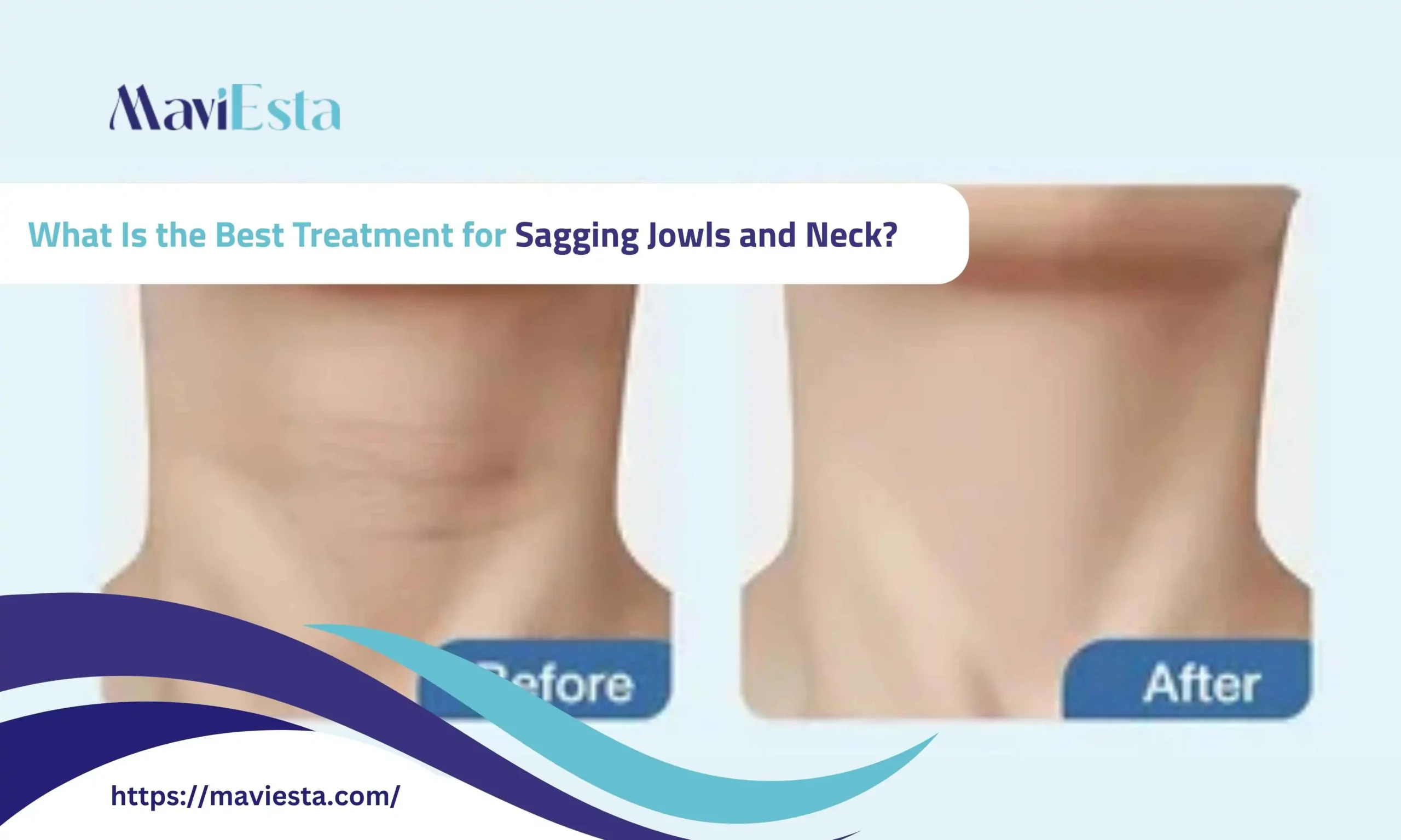 What Is the Best Treatment for Sagging Jowls and Neck