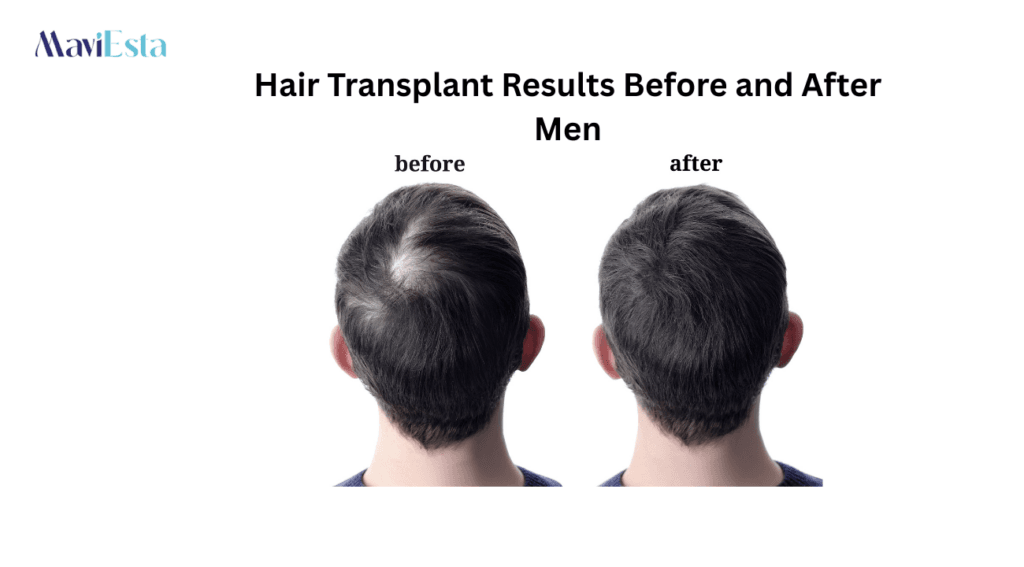Hair Transplant Results Before and After Men