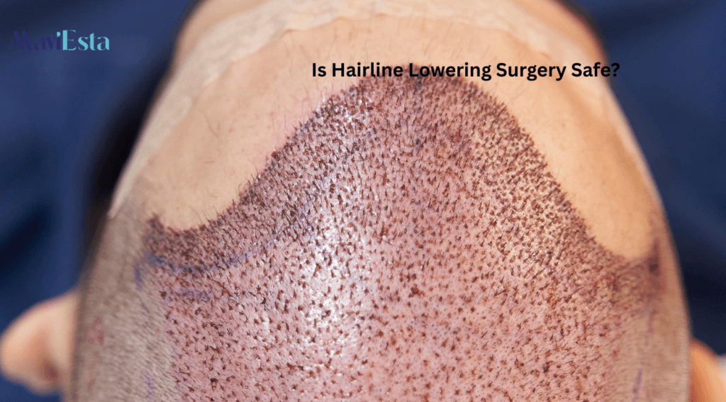 Is Hairline Lowering Surgery Safe?