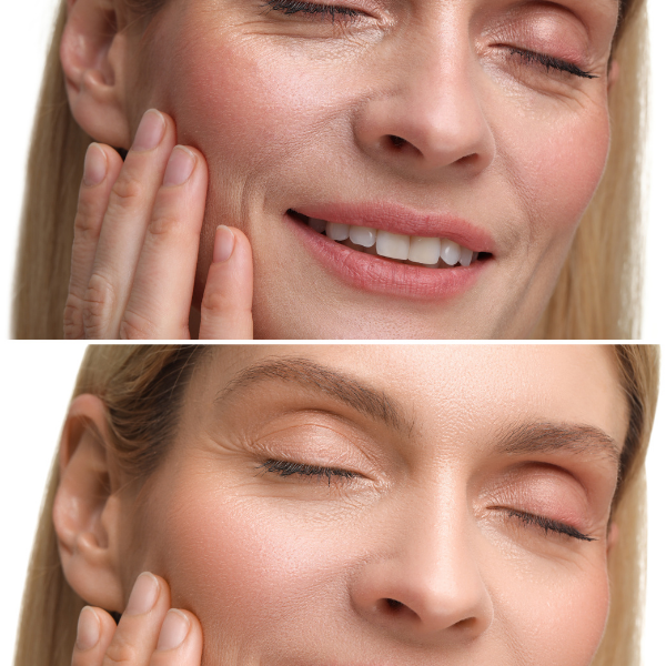 Rhinoplasty Before and After Photos