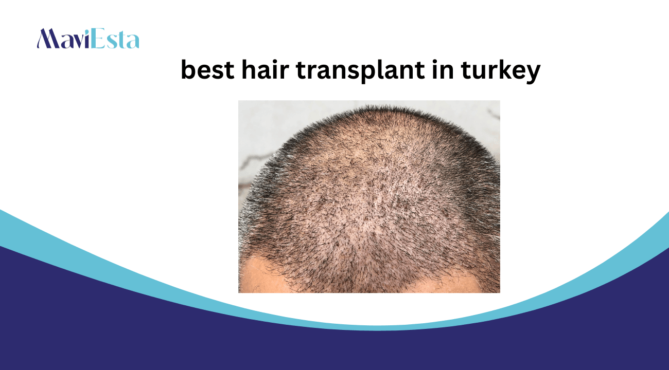 best hair transplant in turkey