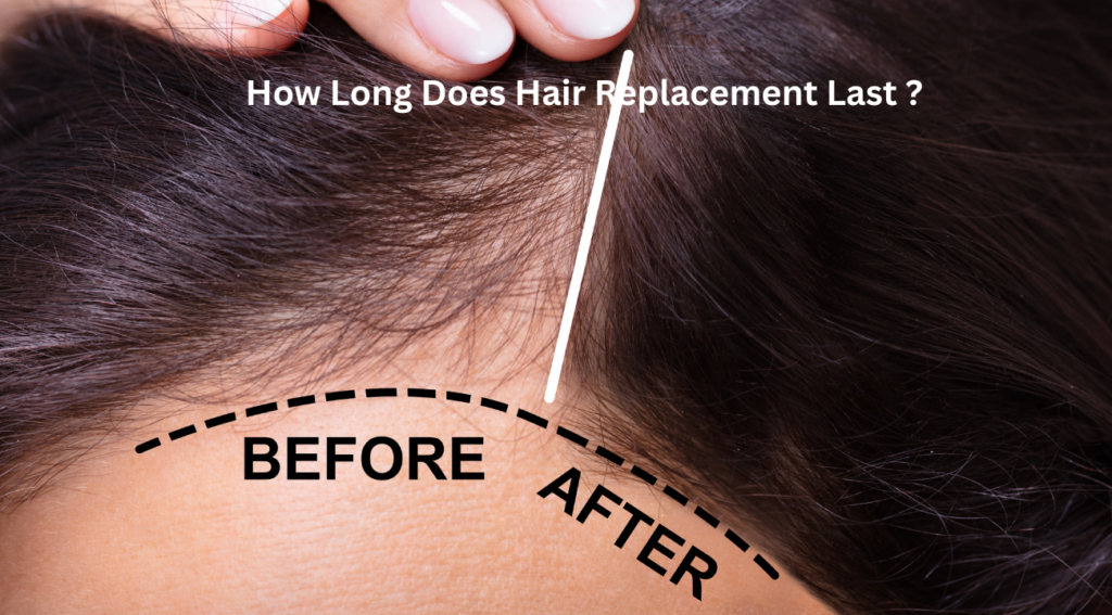 How Long Does Hair Replacement Last ?