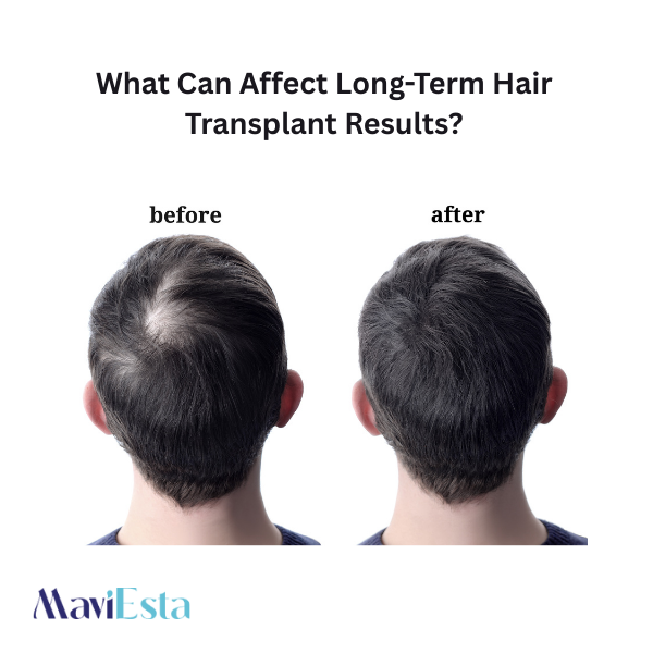 What Can Affect Long-Term Hair Transplant Results?
