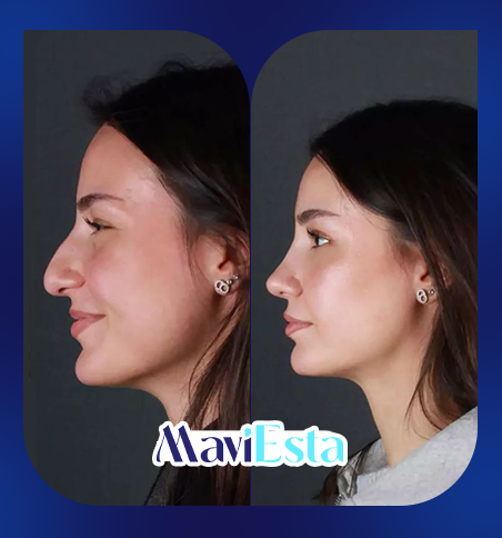 Rhinoplasty 14 Slide 4