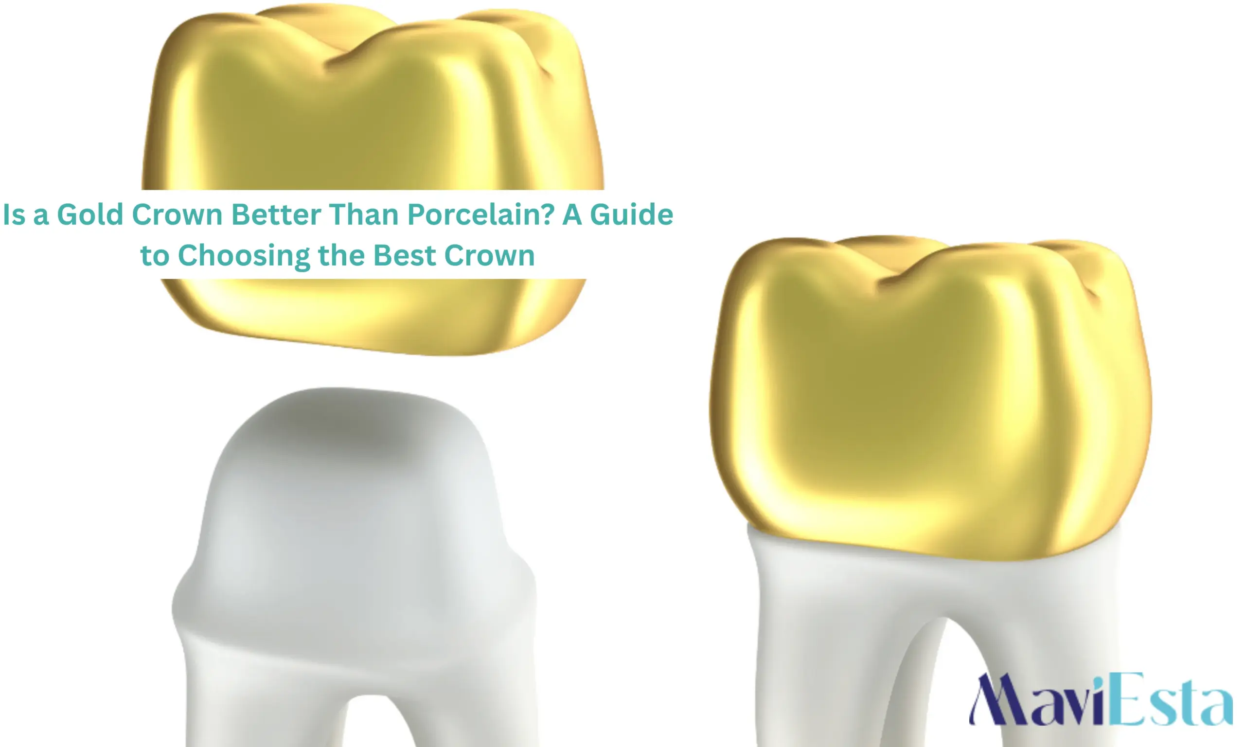 Is a Gold Crown Better Than Porcelain