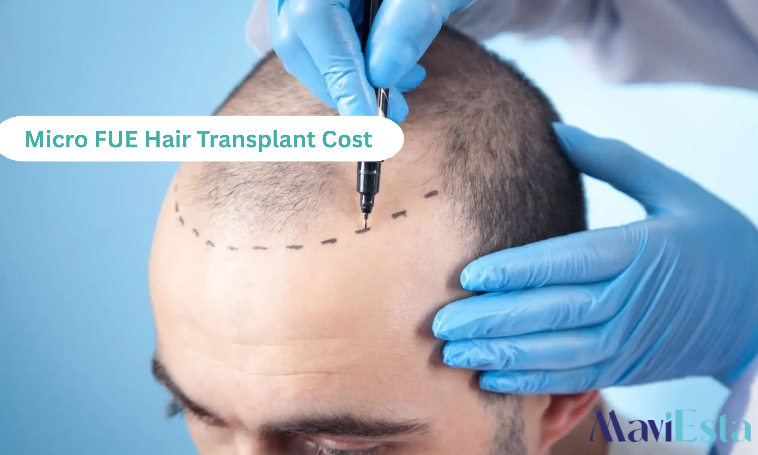 Micro FUE Hair Transplant Cost