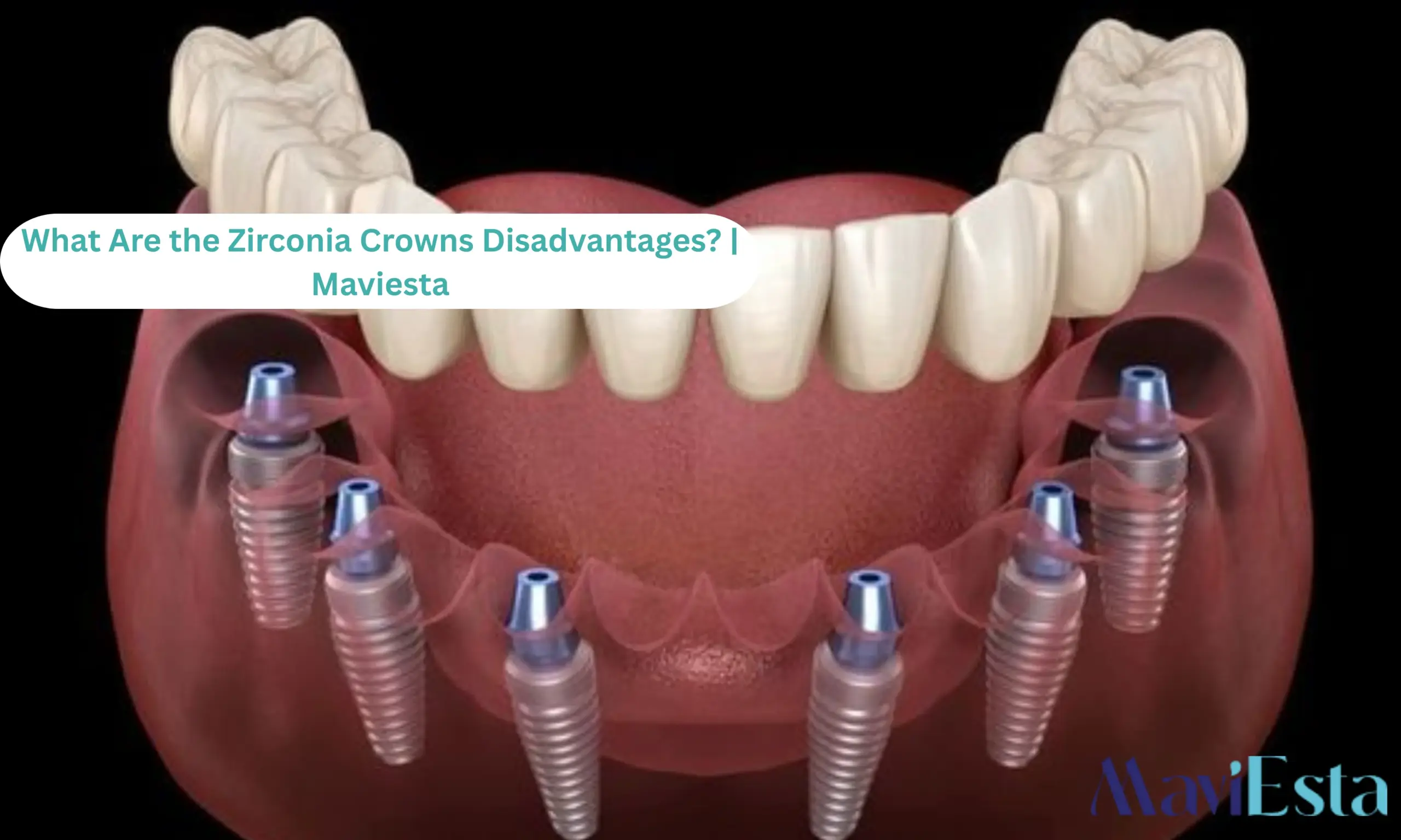 What Are the Zirconia Crowns Disadvantages