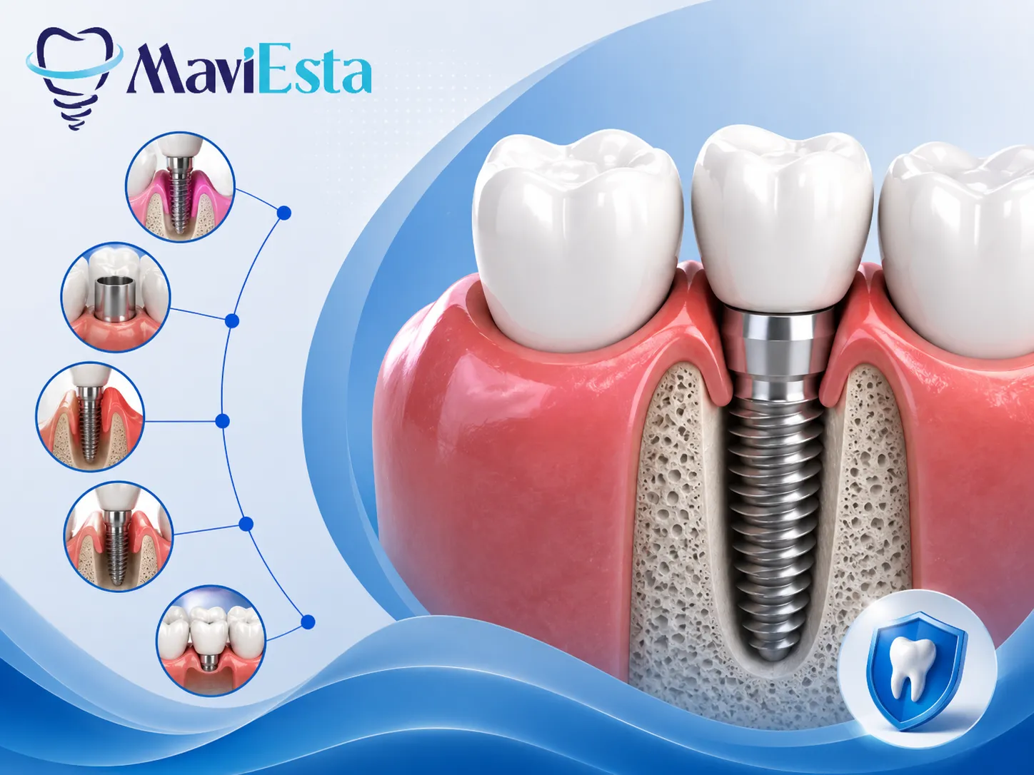 Dental Implant Through My Gum